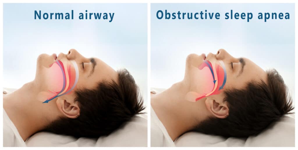 sleep apnea devices | Northstar Dental Greeley