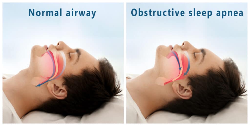 sleep-apnea-snoring-guards-premier-dental-center-ferndale-wa